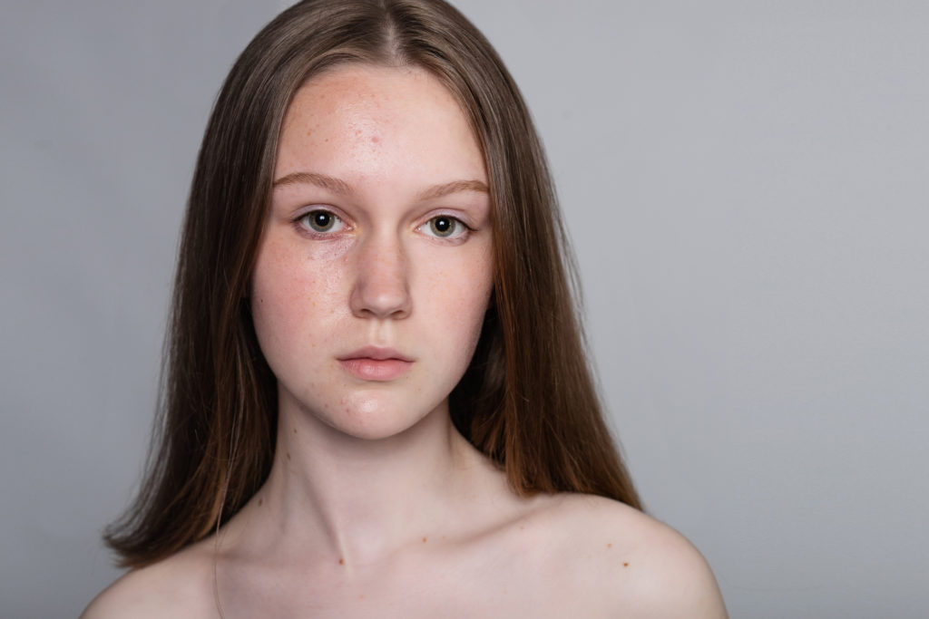 acne-giovanile